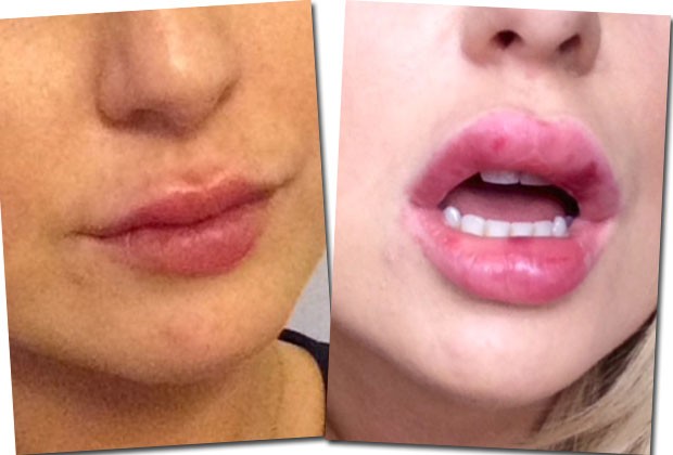 À esquerda: os lábios de Chloe duas horas após o preenchimento. À direira: um dia depois, com alguns hematomas (Foto: Reprodução/Marie Claire EUA)